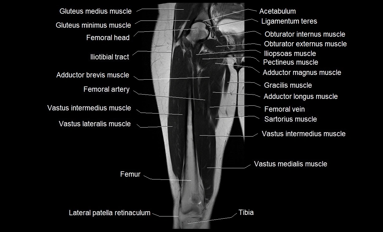 MRI thigh coronal cross sectional anatomy image 10.webp